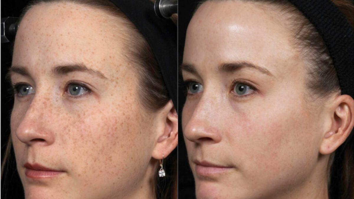 Facial Before and After