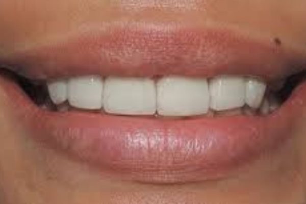 veneers in Tijuana