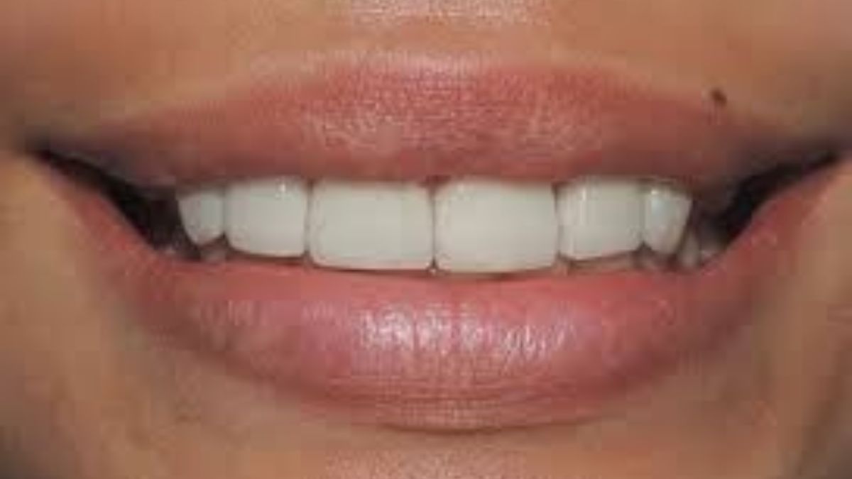 veneers in Tijuana